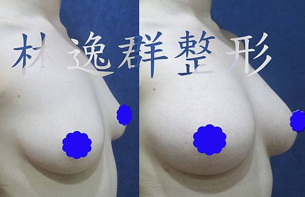 1512xx脂肪隆乳半年右45面拷貝.jpg