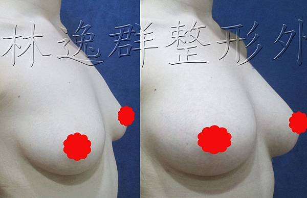 1512xx脂肪隆乳半年右45面拷貝.jpg