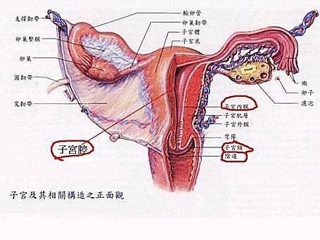 子宮內膜異位