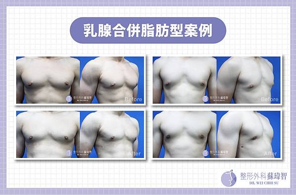 男性女乳手術-乳腺合併脂肪型案例.jpg