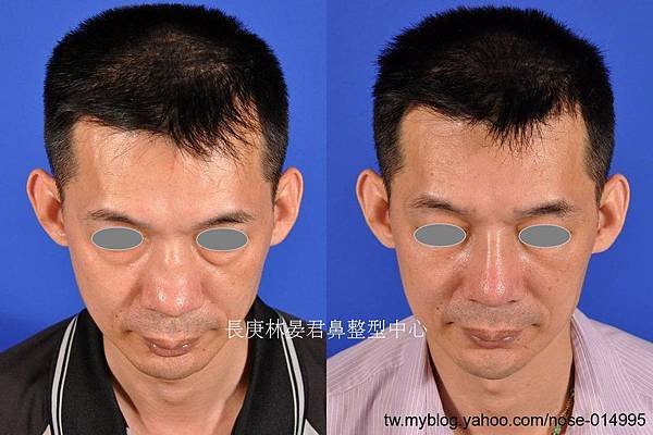 塌鼻 馬鞍鼻 自體脂肪注射 回春 鼻整形 (2).jpg
