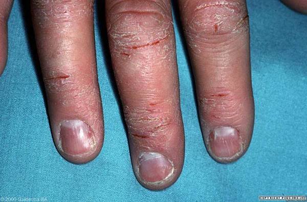 hand eczema 2