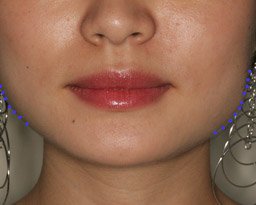 botox-front-dots-bef.jpg