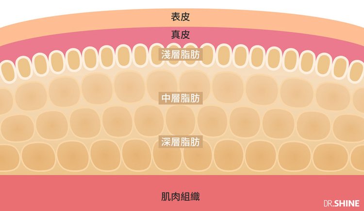 光澤診所複合式抽脂仰臥起坐複肌水刀抽脂雷射溶脂超音波抽脂 (2).jpg