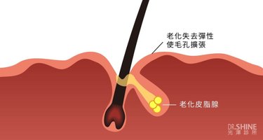 光澤診所毛孔粗大皮秒雷射蜂巢透鏡果酸杏仁酸複合式雷射面膜精華液 (4).jpg