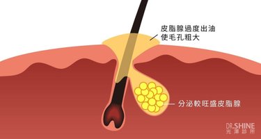 光澤診所毛孔粗大皮秒雷射蜂巢透鏡果酸杏仁酸複合式雷射面膜精華液 (8).jpg