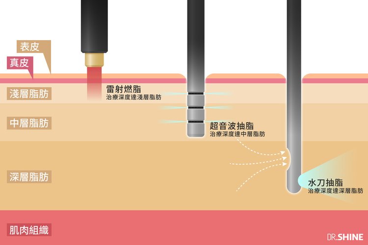 台北抽脂手術光澤診所水刀抽脂雷射溶脂超音波抽脂副作用價格費用複合式抽脂手術 