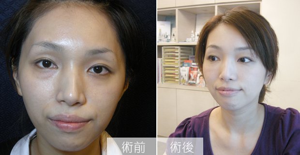 玻尿酸1.jpg