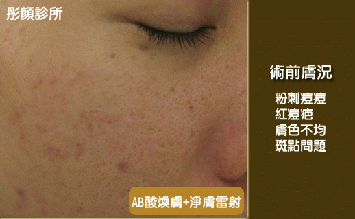淨膚雷射.gif