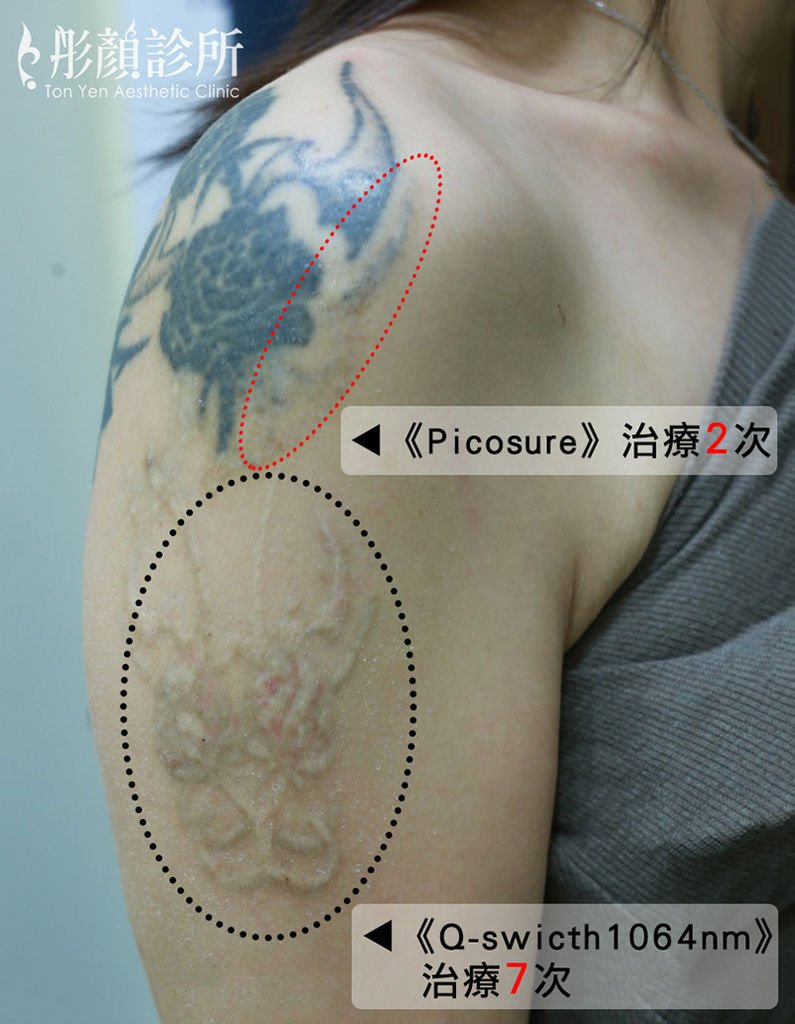 5刺青案例.jpg