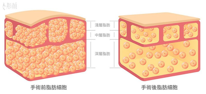 彤顏診所-桃園中壢-抽脂-瘦手臂-複合式抽脂