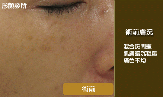 雷射除斑點.gif