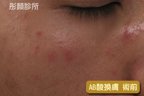 AB酸換膚1.gif