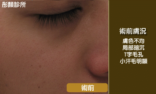 纖白光瞬白光_雞尾酒雷射.gif