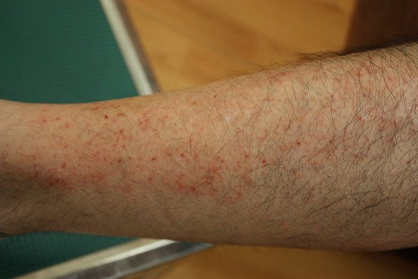 acute asteatotic dermatitis.JPG