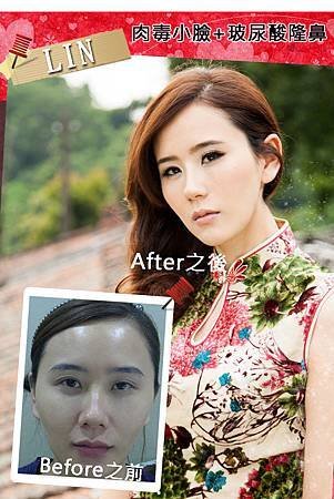 朵特菈素人隆鼻