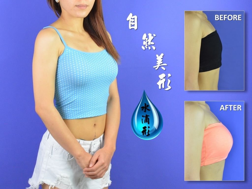 [水滴形果凍隆乳] 圖二：水滴型果凍矽膠隆乳手術的效果
