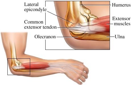 lateral-epicondyle-anatomy-of-tennis-elbow-medial-common-extensor-tendon-olecranon-ulna-extensor-muscle-humerus.jpg