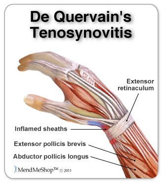 De-Quervain%5Cs-Tenosynovitis.jpg