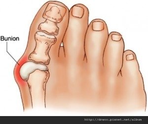 bunion-300x250.jpg