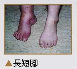 長短腳病例.jpg
