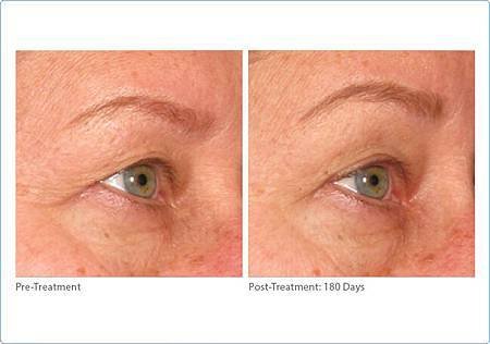 brow-ultherapy1