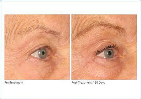 brow-ultherapy2