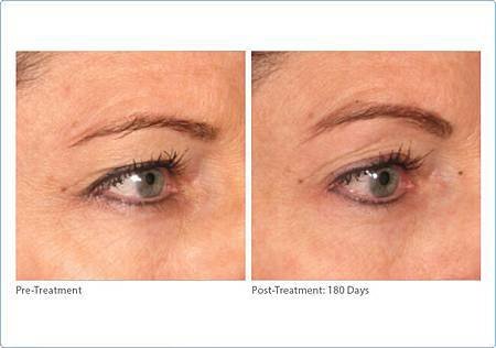 brow-ultherapy3