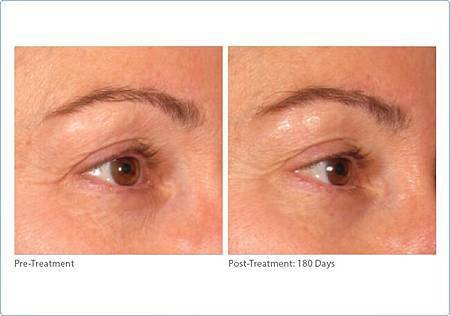 brow-ultherapy4