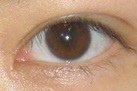 lu-ptosis-1-rev-1