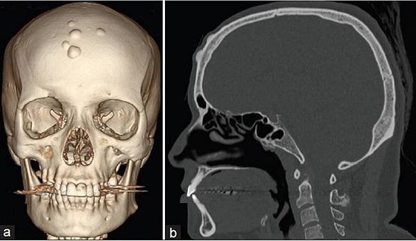 lateral x ray