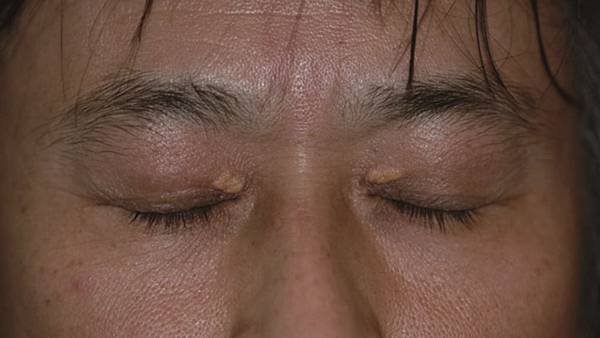 xanthelasma1