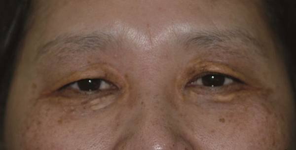 xanthelasma4