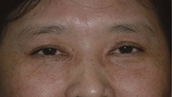 xanthelasma5