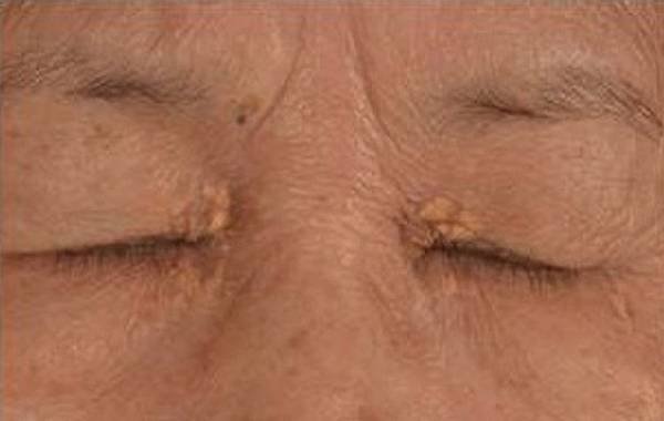 xanthelasma6