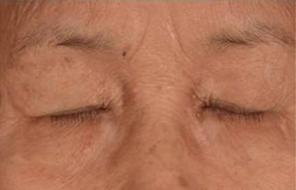 xanthelasma7