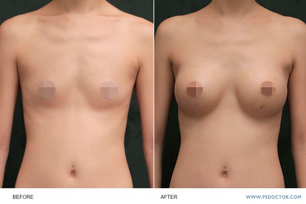 breast-case02-1