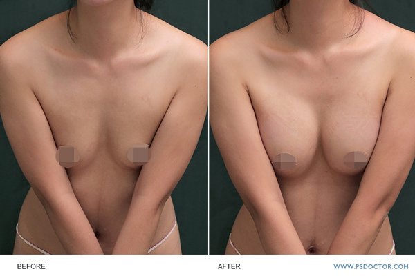 breast-case03-2