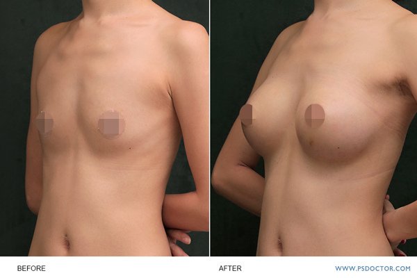 breast-case02-2