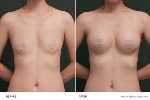 breast-case03-1