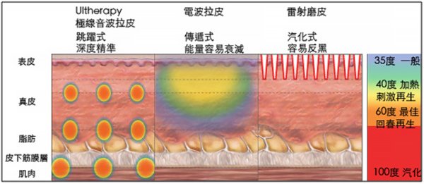 ultherapy-02.jpg