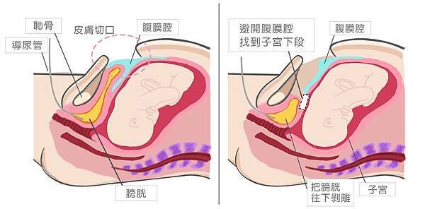 腹膜外300dpi