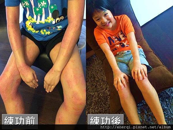 香港濕疹2.jpg