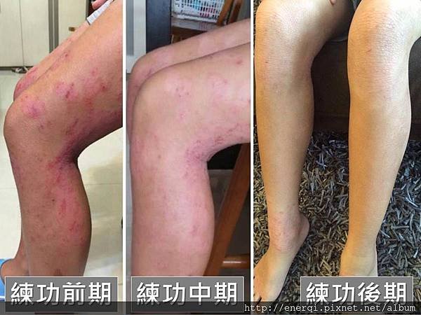 香港濕疹1.jpg