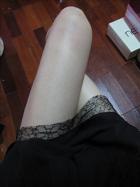 元和雅高雄台南診所-雷射減脂瘦大腿-案例照片分析-Kate-08.jpg