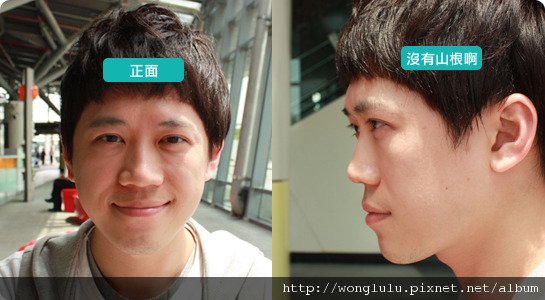 元和雅_膠原蛋白隆鼻_膠原蛋白蘋果肌＿南部高雄台南＿微晶瓷隆鼻案例照片