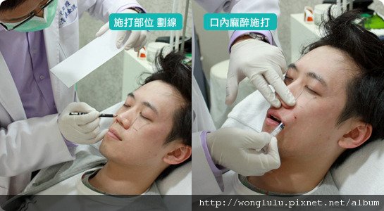 元和雅_膠原蛋白隆鼻_膠原蛋白蘋果肌＿南部高雄台南＿微晶瓷隆鼻案例照片