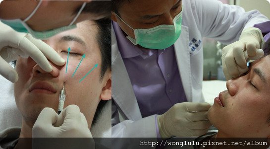 元和雅_膠原蛋白隆鼻_膠原蛋白蘋果肌＿南部高雄台南＿微晶瓷隆鼻案例照片