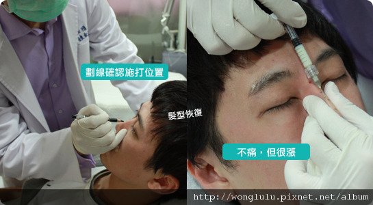 元和雅_膠原蛋白隆鼻_膠原蛋白蘋果肌＿南部高雄台南＿微晶瓷隆鼻案例照片