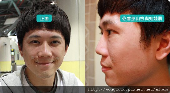 元和雅_膠原蛋白隆鼻_膠原蛋白蘋果肌＿南部高雄台南＿微晶瓷隆鼻案例照片